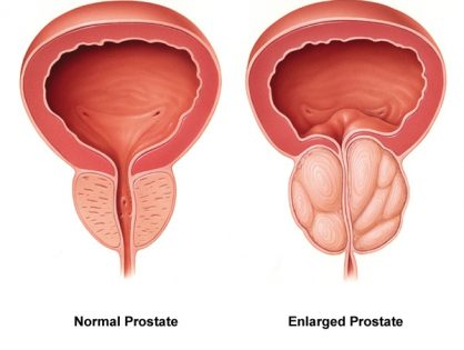 You are currently viewing Prostate Supplement review: Prostan Plus